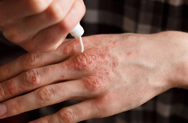 Un nou medicament pentru tratarea psoriazisului va fi scos pe piata