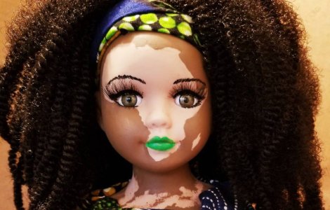 Au aparut papusile cu vitiligo pentru copiii care sufera de aceasta boala
