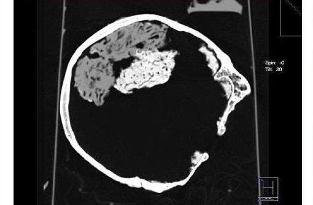 S-a descoperit un creier de 2.500 de ani