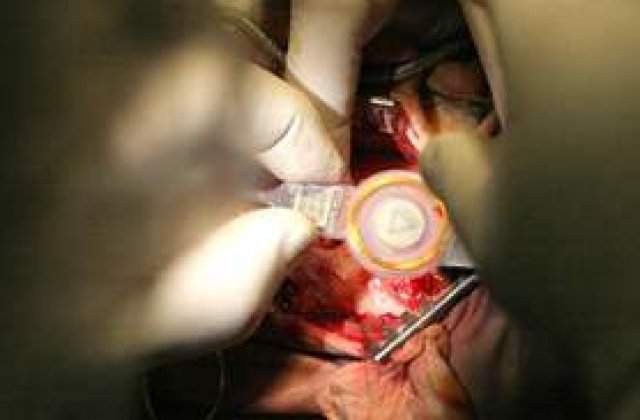 Marirea sanilor - cea mai frecventa operatie estetica din Romania