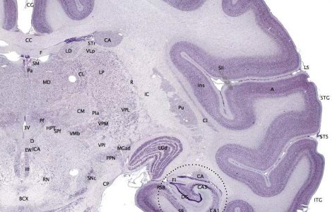 Primul indiciu in identitificarea Alzheimerului