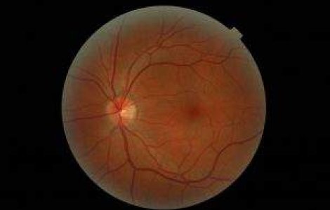  Top  Ochiul bionic le poate "reda" orbilor vederea