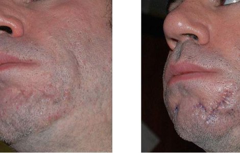 Cum "stergi" vergeturile, cicatricile si ridurile profunde?