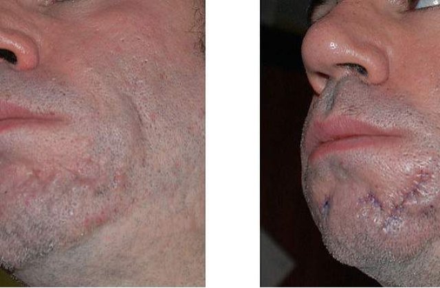 Cum "stergi" vergeturile, cicatricile si ridurile profunde?