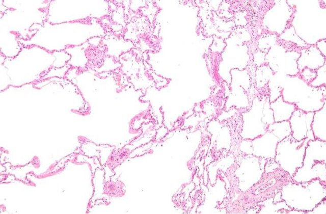Pe viitor, maladiile pulmonare vor putea fi vindecate!