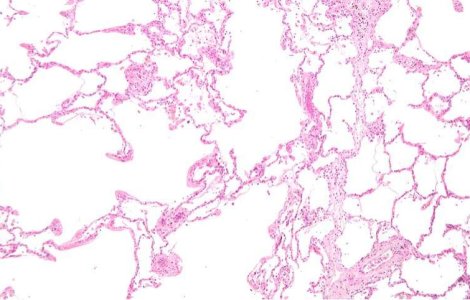 Pe viitor, maladiile pulmonare vor putea fi vindecate!