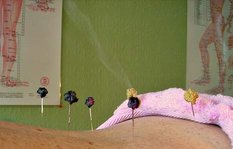 Acupunctura, metoda terapeutica milenara