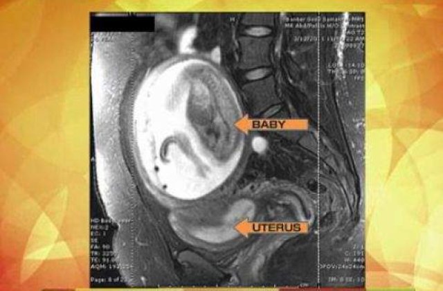 [VIDEO] `Copilul minune`: Perfect sanatos, desi s-a nascut in afara uterului