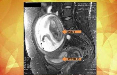  Video  `Copilul minune`: Perfect sanatos, desi s-a nascut in afara uterului