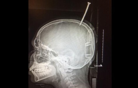 Un baiat de 13 ani a ajuns la spital cu craniul perforat de un surub, dupa ce a cazut dintr-un copac