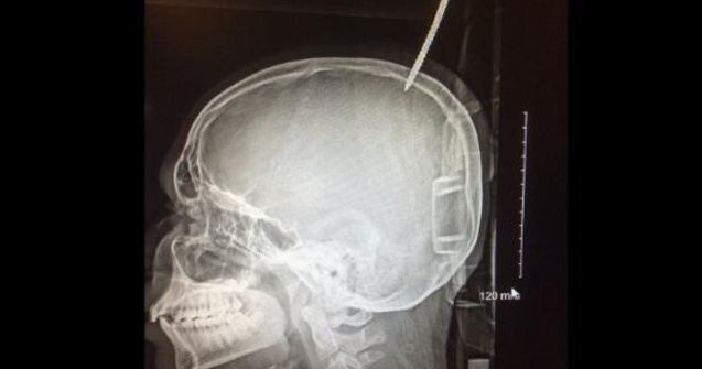 Un baiat de 13 ani a ajuns la spital cu craniul perforat de un surub, dupa ce a cazut dintr-un copac