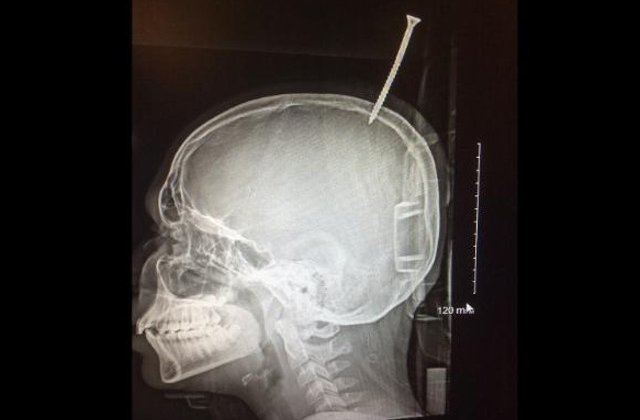 Un baiat de 13 ani a ajuns la spital cu craniul perforat de un surub, dupa ce a cazut dintr-un copac