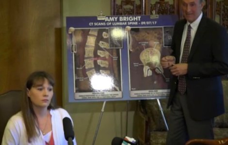 Motivul pentru care o femeie a trait 14 ani cu un ac in coloana vertebrala