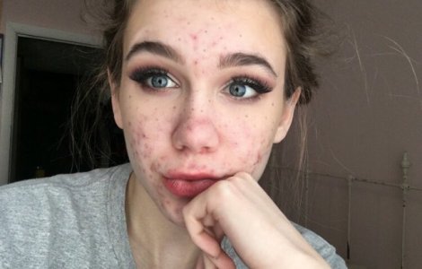 Medicamentele pentru acnee aproape au orbit-o pe o adolescenta de 15 ani
