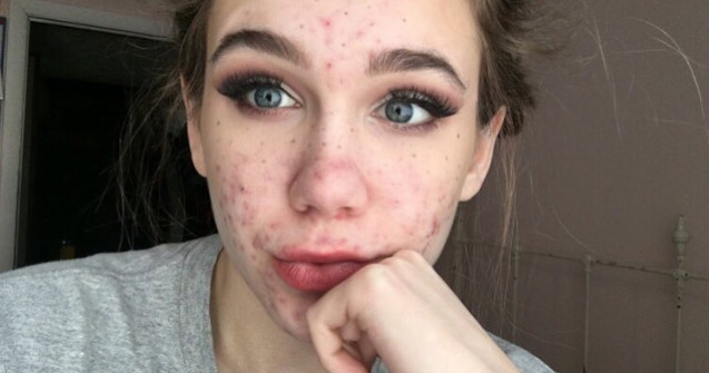 Medicamentele pentru acnee aproape au orbit-o pe o adolescenta de 15 ani