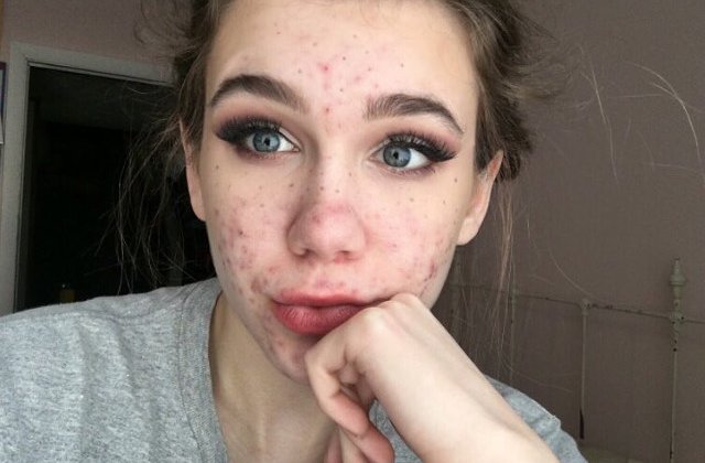 Medicamentele pentru acnee aproape au orbit-o pe o adolescenta de 15 ani