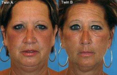 Efectele fumatului asupra infatisarii