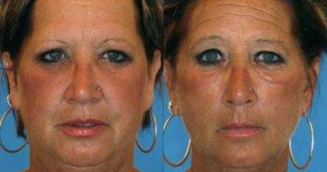 Efectele fumatului asupra infatisarii