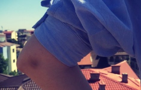  Top  10 remedii naturale care te scapa de petele negre de pe genunchi si coate