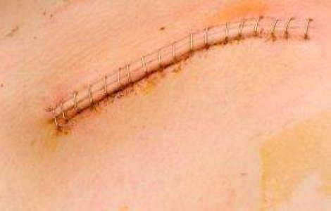 Piele umana antiglont, din lapte de capra