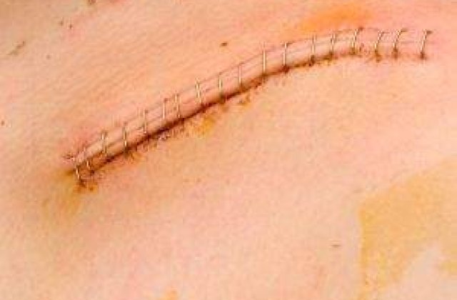 Piele umana antiglont, din lapte de capra