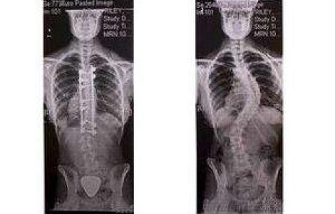 Operatia la coloana i-a deschis calea spre modeling