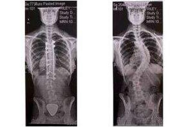 Operatia la coloana i-a deschis calea spre modeling