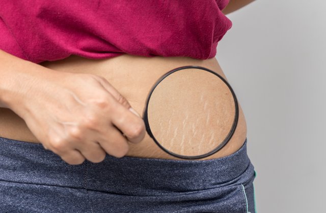 7 remedii naturale pentru a scapa de vergeturi intr-un mod eficient