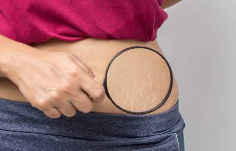  Top  7 remedii naturale pentru a scapa de vergeturi intr-un mod eficient