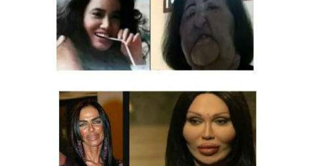  Top  Cele mai nereusite operatii estetice