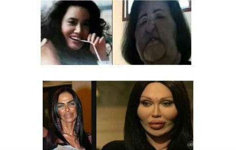  Top  Cele mai nereusite operatii estetice