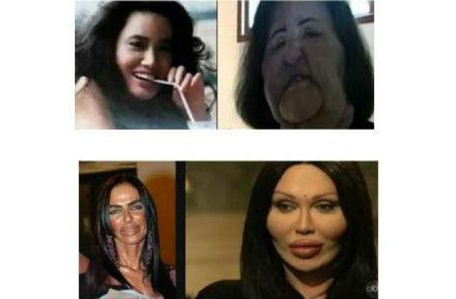 Cele mai nereusite operatii estetice