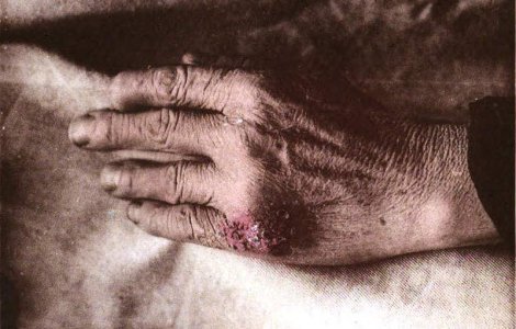 Care sunt cele mai raspandite idei gresite despre Lupus?