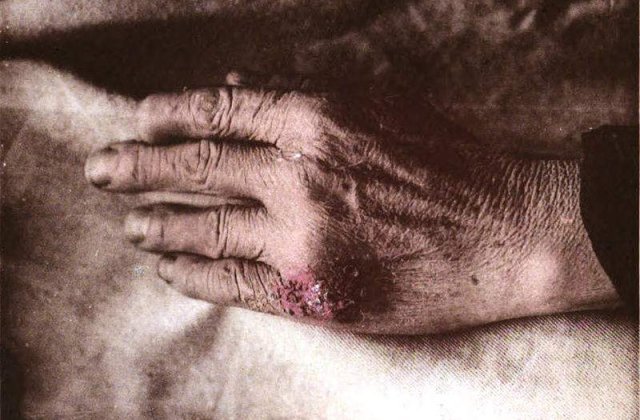 Care sunt cele mai raspandite idei gresite despre Lupus?