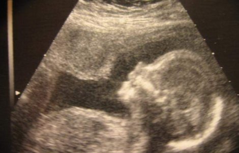 Cate cupluri au beneficiat de fertilizare in vitro?