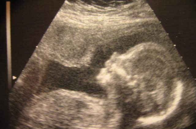 Cate cupluri au beneficiat de fertilizare in vitro?