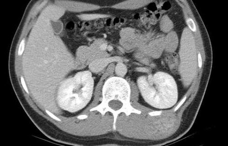 Un barbat a trait cu o tumoare cat un om