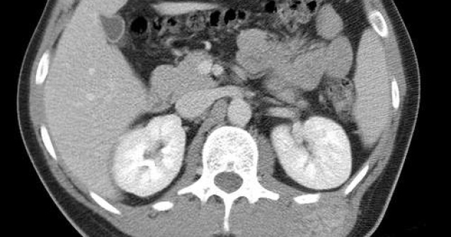 Un barbat a trait cu o tumoare cat un om