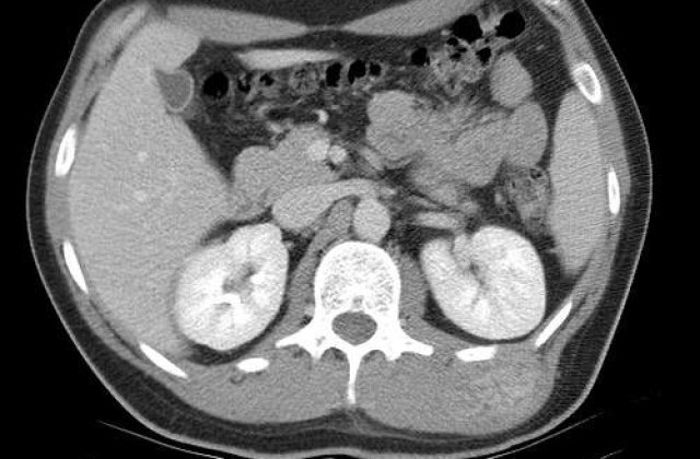 Un barbat a trait cu o tumoare cat un om