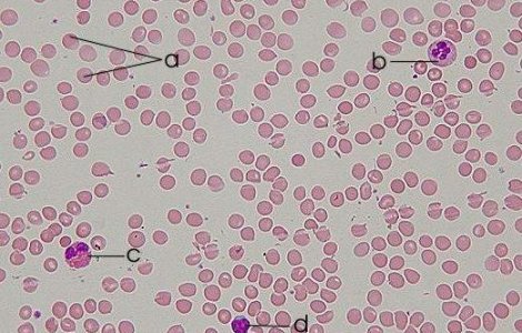 S-a descoperit un leac pentru leucemie?
