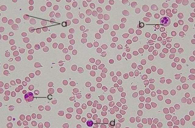 S-a descoperit un leac pentru leucemie?