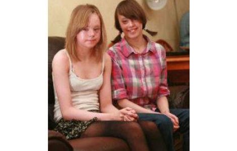 Doua surori s-au nascut cu piele de sarpe