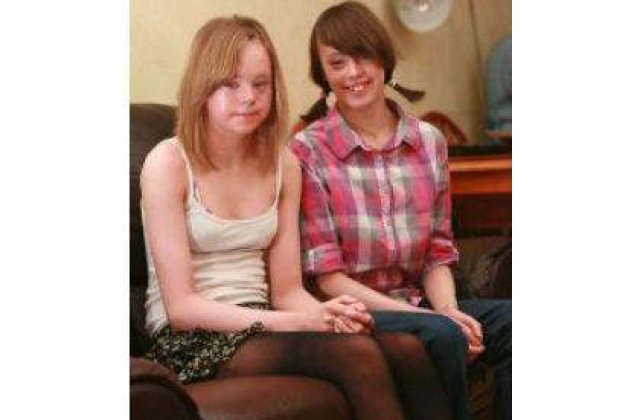 Doua surori s-au nascut cu piele de sarpe