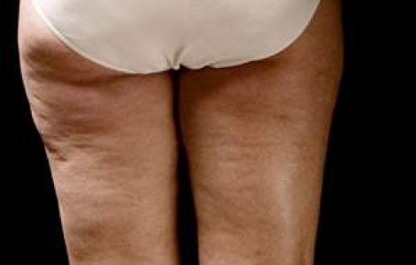 Crema-minune: Distruge celulita in doar 9 minute!