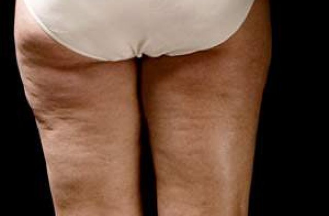 Crema-minune: Distruge celulita in doar 9 minute!