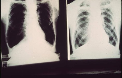 Alerta de TBC intr-un liceu din Constanta