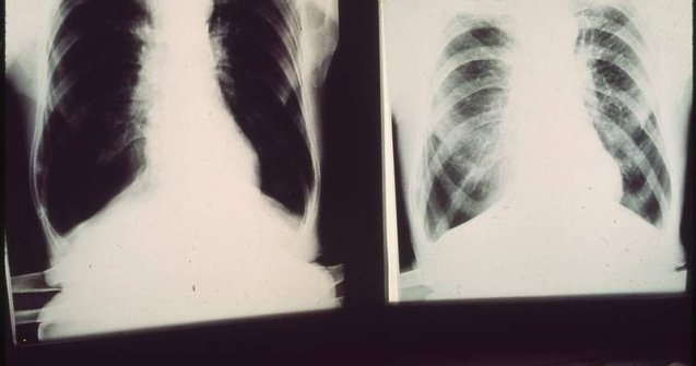 Alerta de TBC intr-un liceu din Constanta