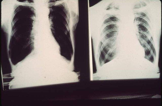 Alerta de TBC intr-un liceu din Constanta