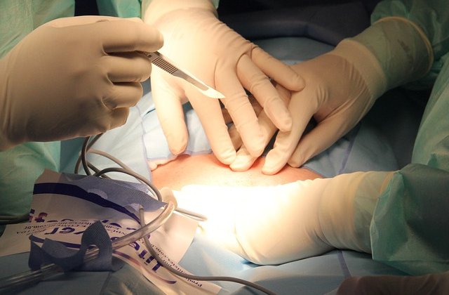 Inca o pacienta operata de Mateo Politi se plange de rezultatul interventiei: "Nasul meu arata ca un snitel batut pe tocator"