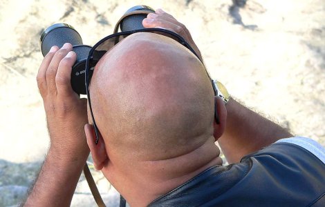 Cercetatorii sunt la un pas de a vindeca cheliile barbatilor